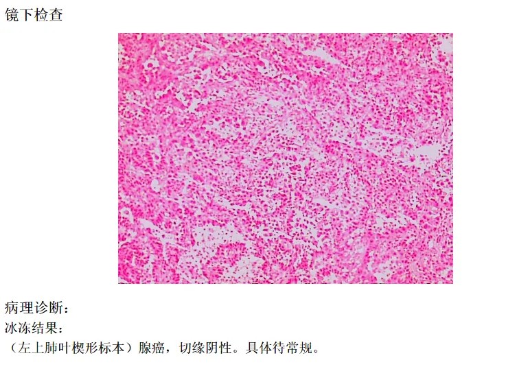 再次突破 | 浙大邵逸夫阿拉尔医院胸外科成功为8旬老人完成“胸腔镜下肺癌手术” 第 2 张